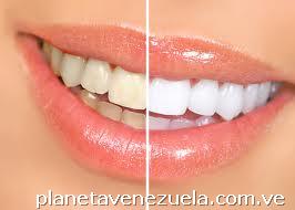 Blanqueamiento dental + Diagnóstico + Limpieza + Pulido en 500