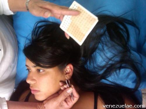 Acupuntura en Caracas