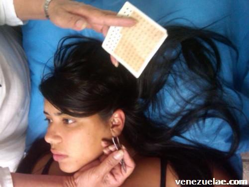 Acupuntura y estética facial